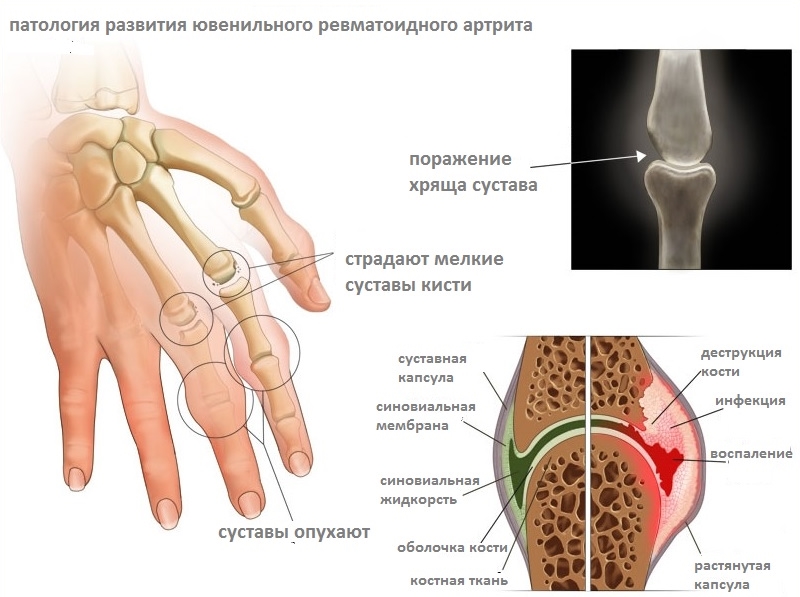 Сто болезней: виды артритов и их диагностика, основные разновидности, каким бывает воспаление суставов 