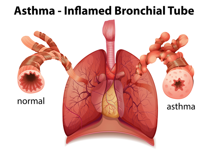 Бронхиальная астма у ребенка: симптомы и лечение 