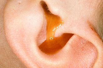 Как остановить выделение жидкости из уха? 