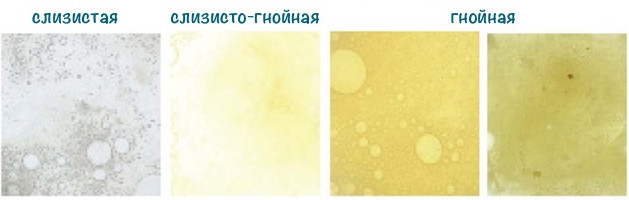 Цвет и характеристики мокроты при хроническом и остром бронхите 